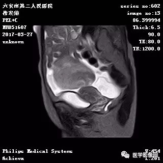 【病例】卵泡膜细胞瘤1例MR 【病例】卵泡膜细胞瘤1例MR