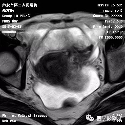 【病例】卵泡膜细胞瘤1例MR 【病例】卵泡膜细胞瘤1例MR