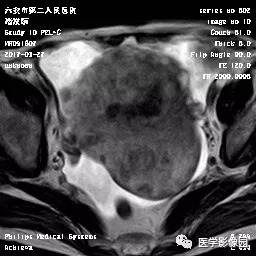 【病例】卵泡膜细胞瘤1例MR 【病例】卵泡膜细胞瘤1例MR
