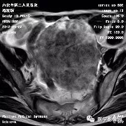 【病例】卵泡膜细胞瘤1例MR 【病例】卵泡膜细胞瘤1例MR
