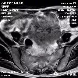 【病例】卵泡膜细胞瘤1例MR 【病例】卵泡膜细胞瘤1例MR
