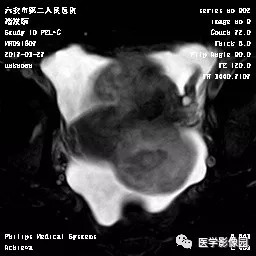 【病例】卵泡膜细胞瘤1例MR 【病例】卵泡膜细胞瘤1例MR