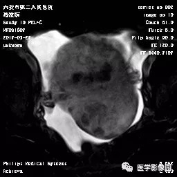 【病例】卵泡膜细胞瘤1例MR 【病例】卵泡膜细胞瘤1例MR