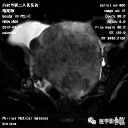 【病例】卵泡膜细胞瘤1例MR 【病例】卵泡膜细胞瘤1例MR