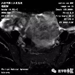【病例】卵泡膜细胞瘤1例MR 【病例】卵泡膜细胞瘤1例MR