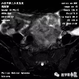 【病例】卵泡膜细胞瘤1例MR 【病例】卵泡膜细胞瘤1例MR