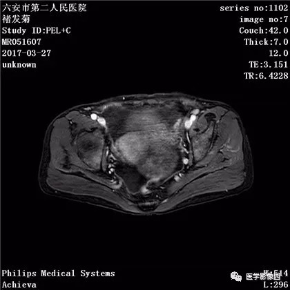 【病例】卵泡膜细胞瘤1例MR 【病例】卵泡膜细胞瘤1例MR