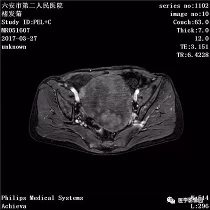 【病例】卵泡膜细胞瘤1例MR 【病例】卵泡膜细胞瘤1例MR