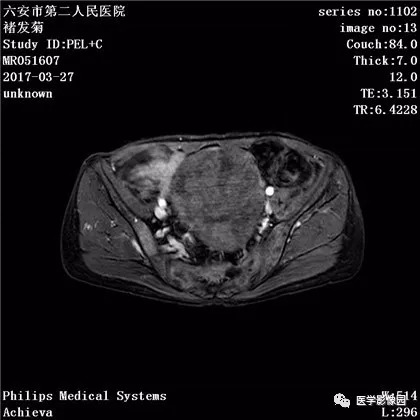 【病例】卵泡膜细胞瘤1例MR 【病例】卵泡膜细胞瘤1例MR