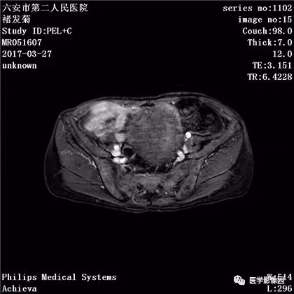 【病例】卵泡膜细胞瘤1例MR 【病例】卵泡膜细胞瘤1例MR
