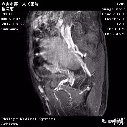 【病例】卵泡膜细胞瘤1例MR 【病例】卵泡膜细胞瘤1例MR