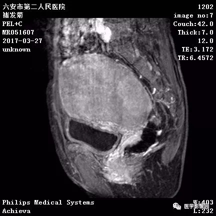 【病例】卵泡膜细胞瘤1例MR 【病例】卵泡膜细胞瘤1例MR