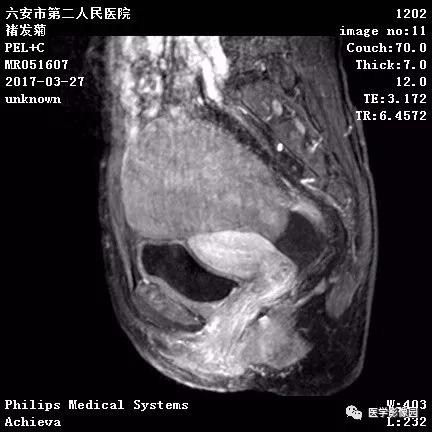 【病例】卵泡膜细胞瘤1例MR 【病例】卵泡膜细胞瘤1例MR