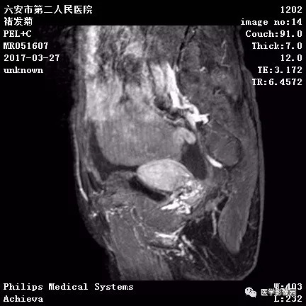 【病例】卵泡膜细胞瘤1例MR 【病例】卵泡膜细胞瘤1例MR