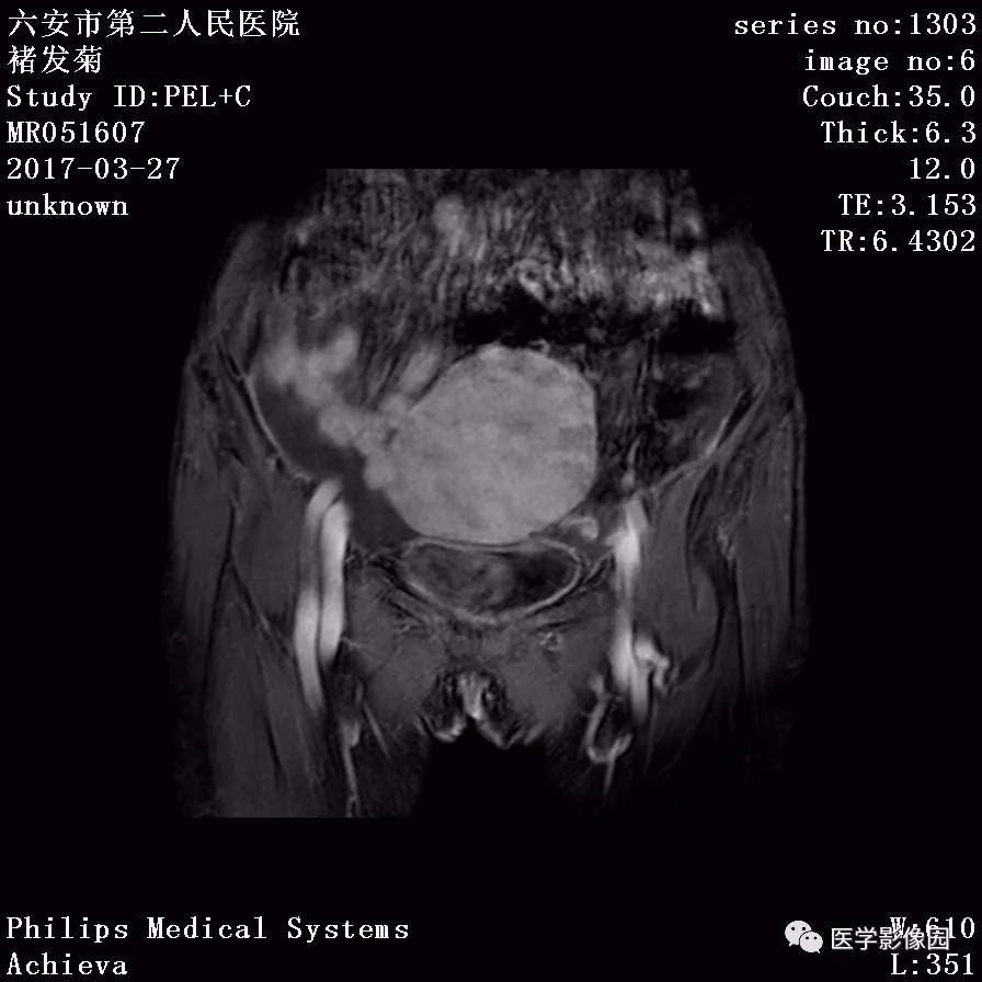 【病例】卵泡膜细胞瘤1例MR 【病例】卵泡膜细胞瘤1例MR