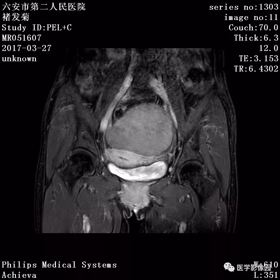 【病例】卵泡膜细胞瘤1例MR 【病例】卵泡膜细胞瘤1例MR