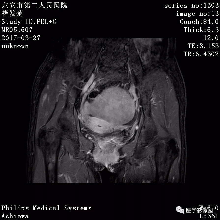 【病例】卵泡膜细胞瘤1例MR 【病例】卵泡膜细胞瘤1例MR