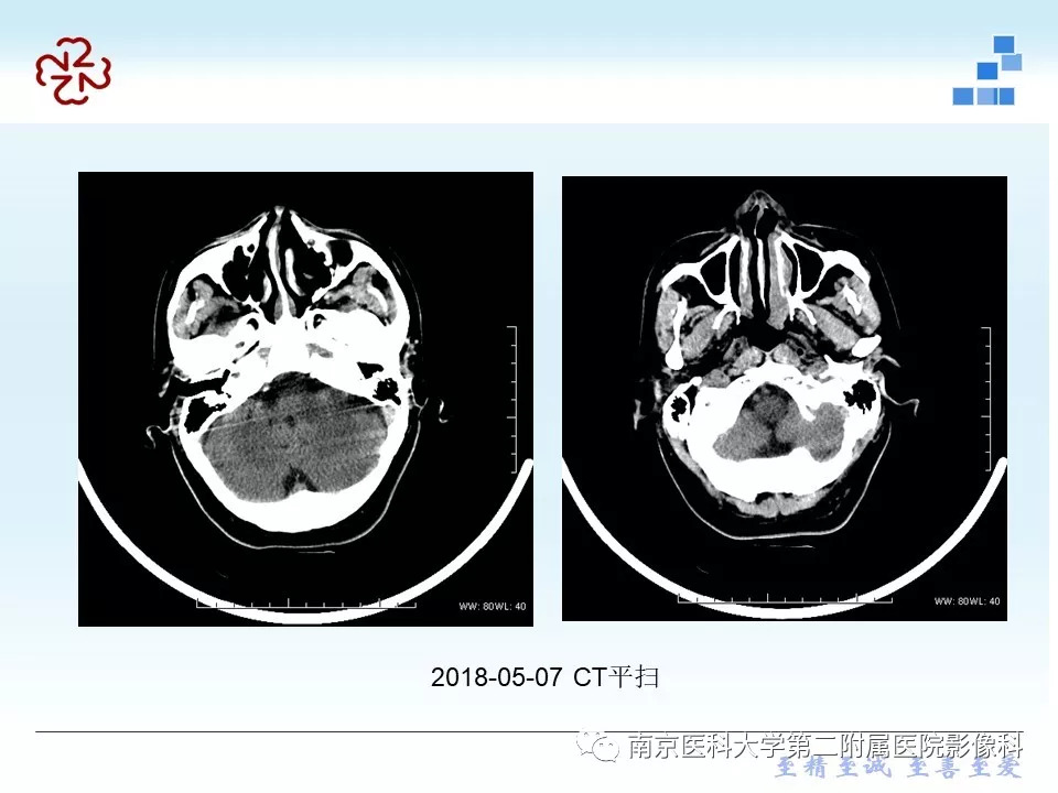 【PPT】脑实质结核瘤影像表现