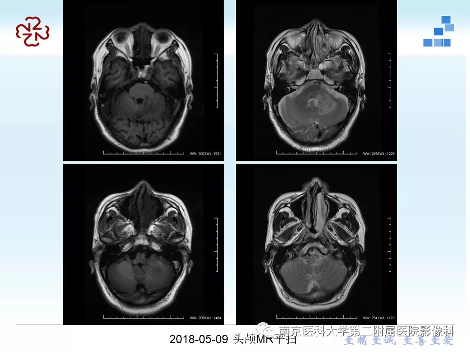 【PPT】脑实质结核瘤影像表现