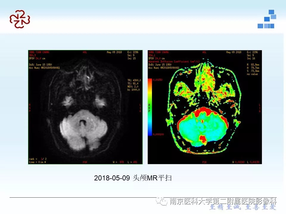 【PPT】脑实质结核瘤影像表现