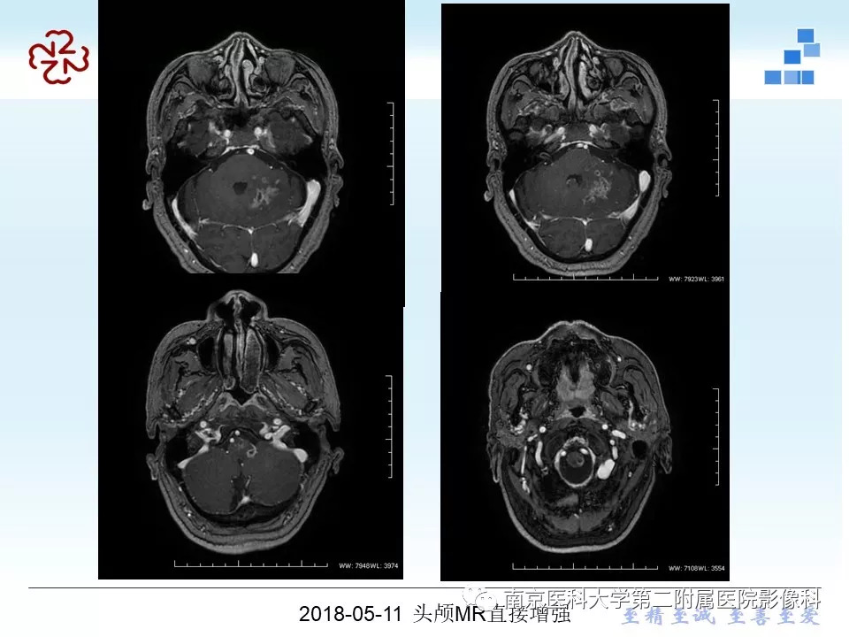 【PPT】脑实质结核瘤影像表现