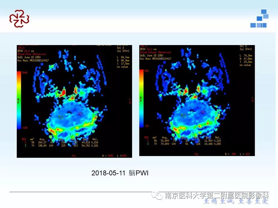 【PPT】脑实质结核瘤影像表现