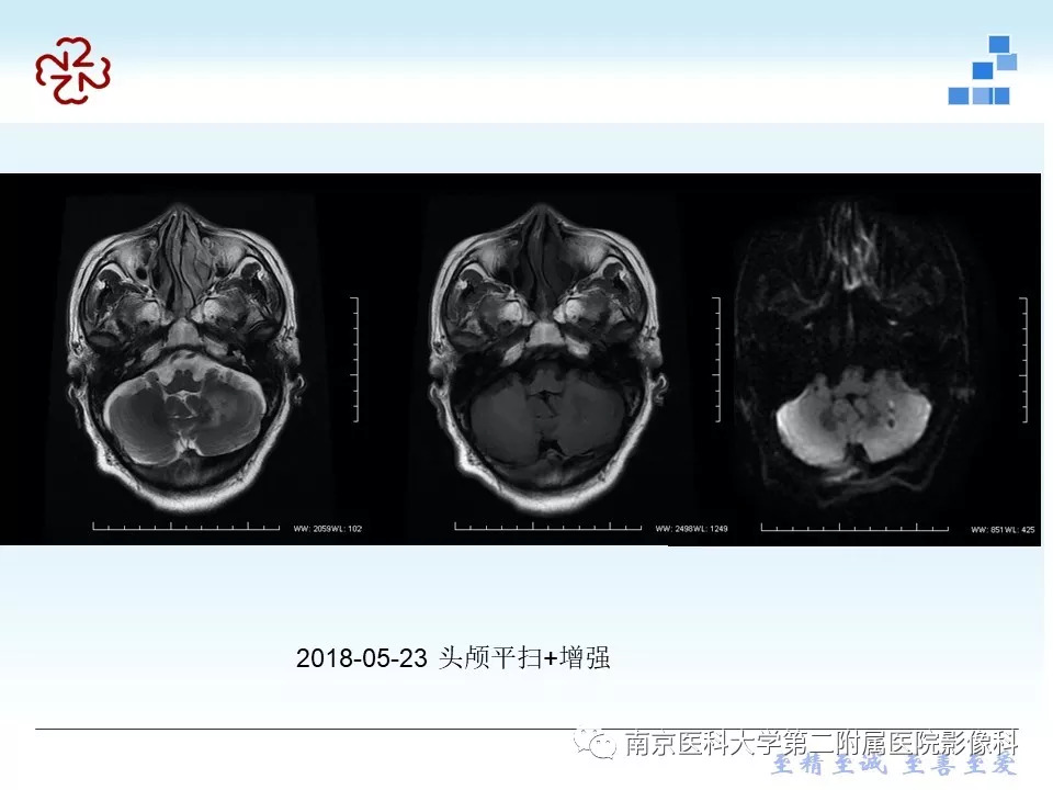 【PPT】脑实质结核瘤影像表现