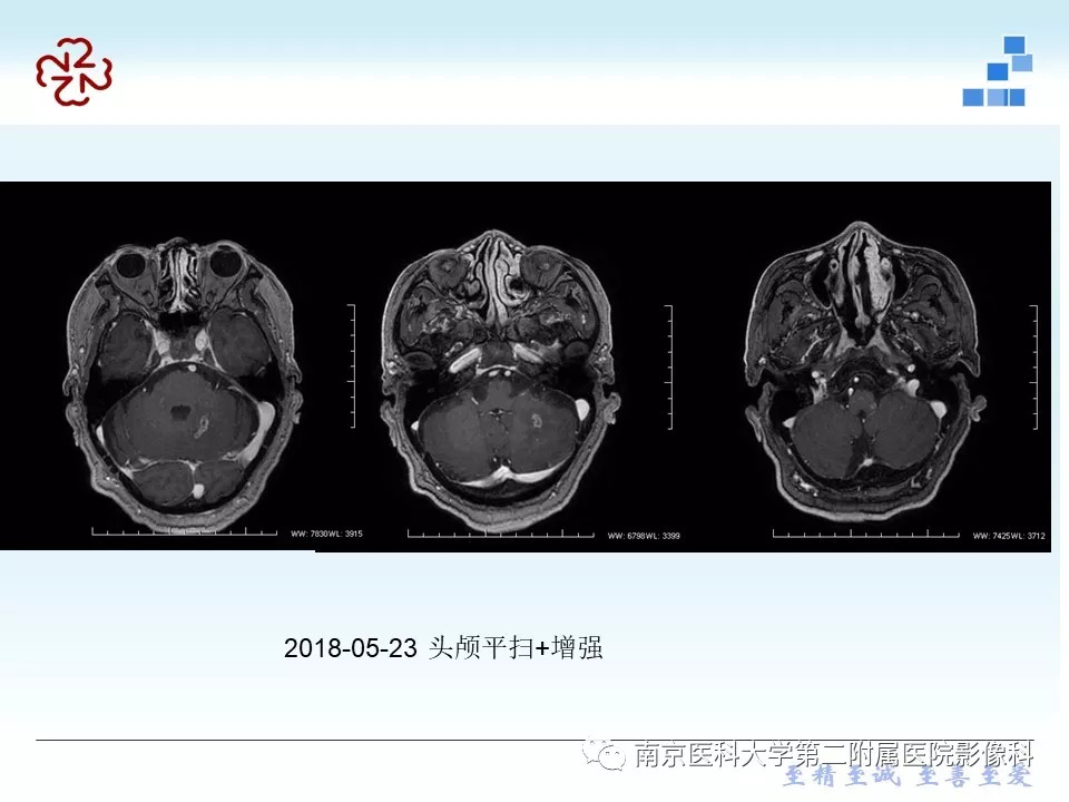 【PPT】脑实质结核瘤影像表现