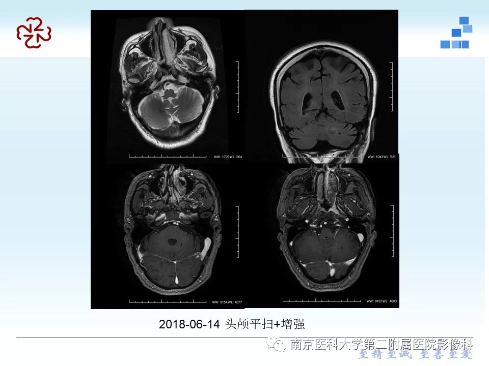 【PPT】脑实质结核瘤影像表现