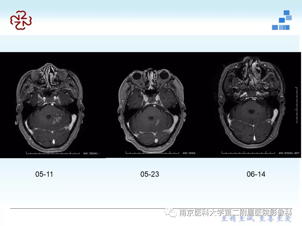 【PPT】脑实质结核瘤影像表现