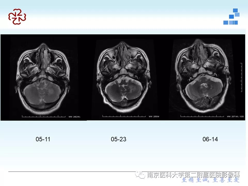 【PPT】脑实质结核瘤影像表现