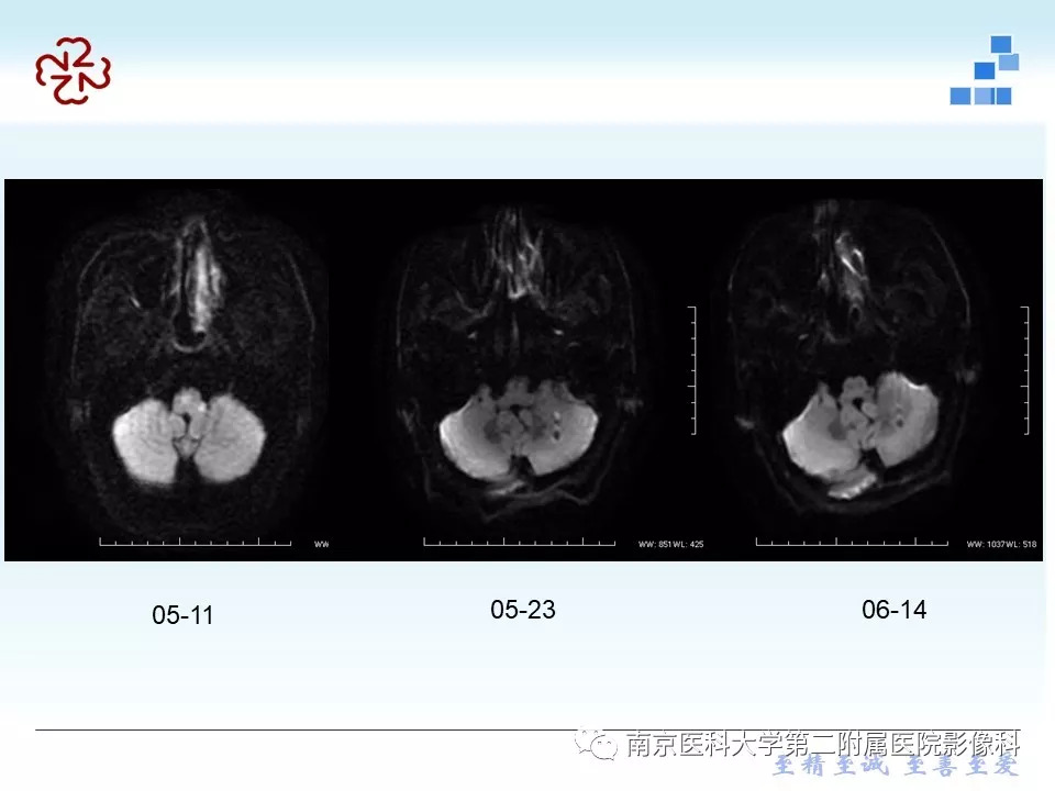 【PPT】脑实质结核瘤影像表现
