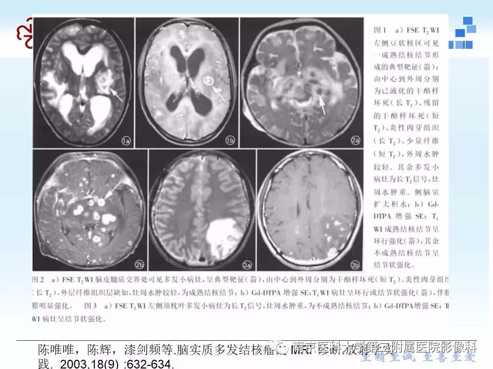 【PPT】脑实质结核瘤影像表现