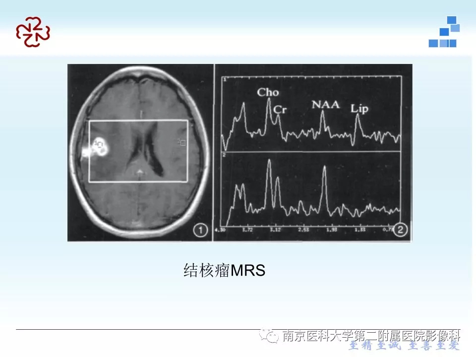 【PPT】脑实质结核瘤影像表现