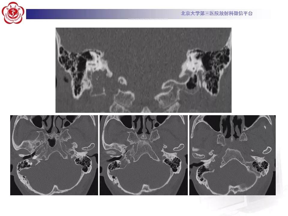 【病例】颅底脊索瘤1例CT及MR