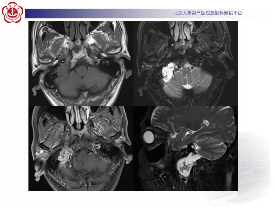 【病例】颅底脊索瘤1例CT及MR