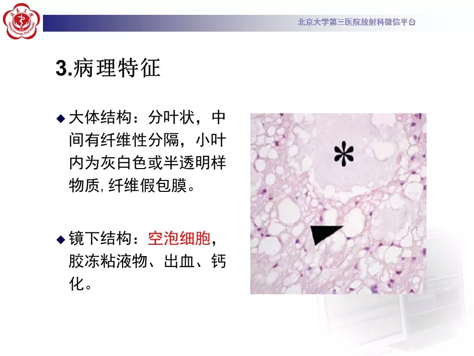 【病例】颅底脊索瘤1例CT及MR
