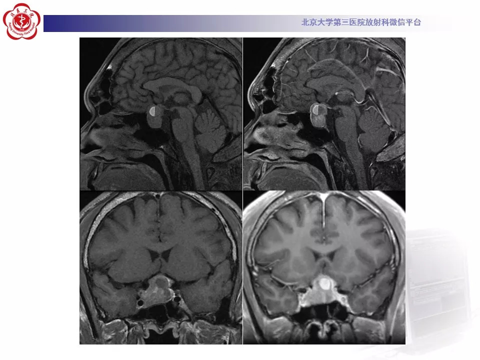 【病例】颅底脊索瘤1例CT及MR