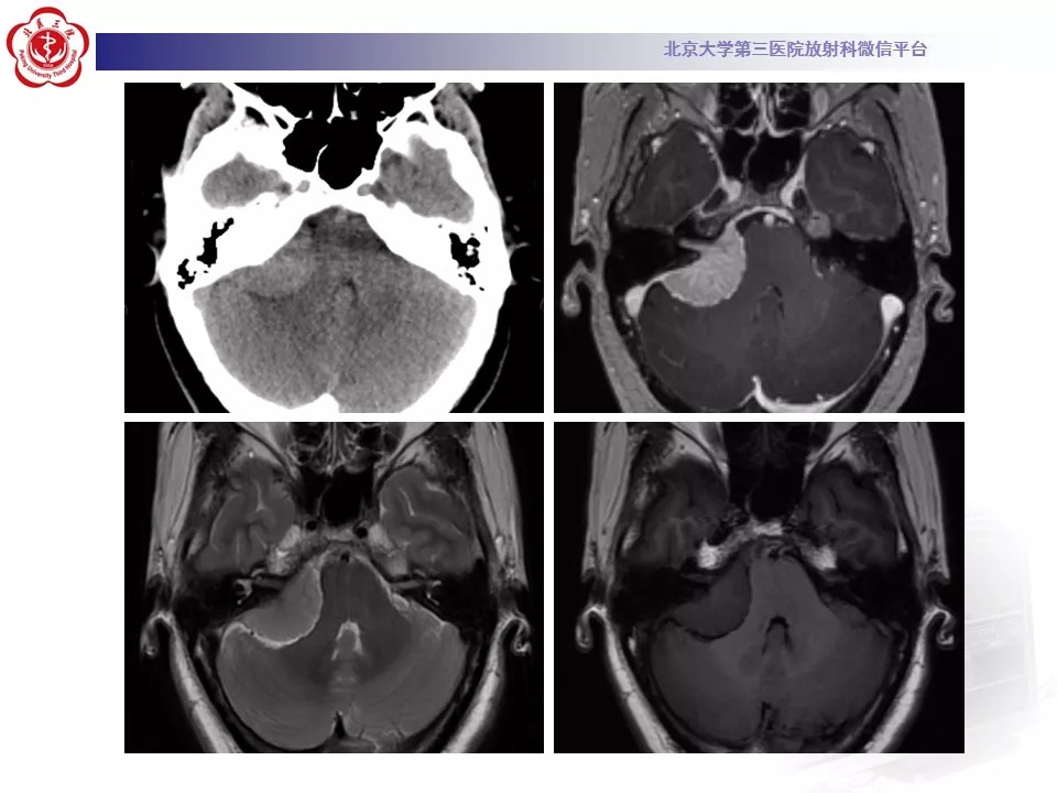 【病例】颅底脊索瘤1例CT及MR