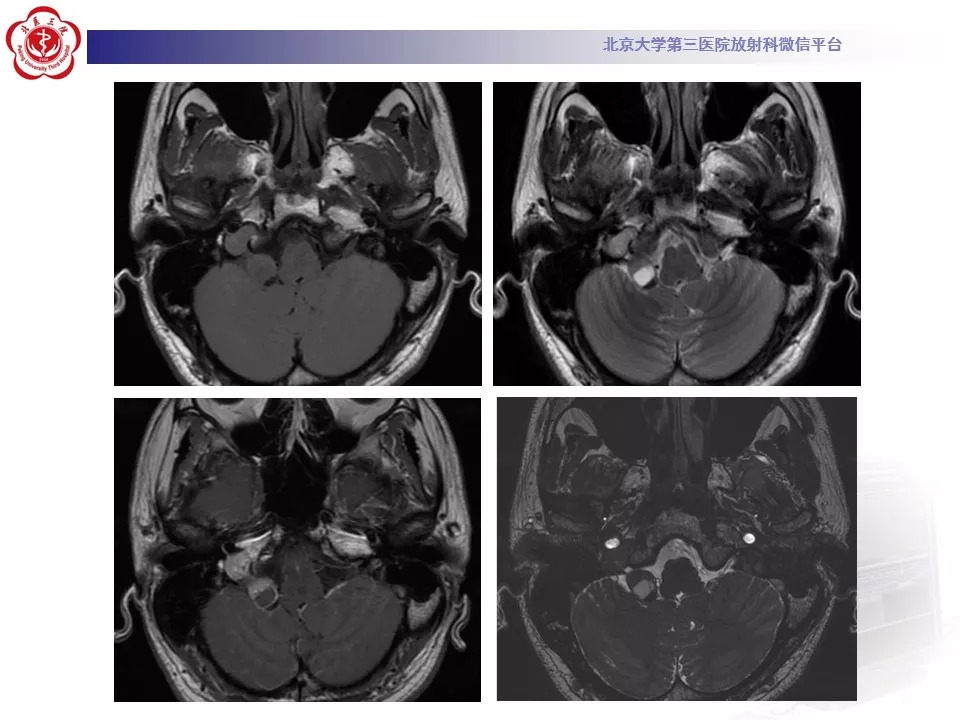 【病例】颅底脊索瘤1例CT及MR