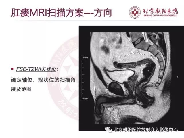 【PPT】肛瘘相关MRI影像学解剖及诊断
