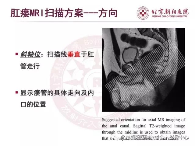 【PPT】肛瘘相关MRI影像学解剖及诊断