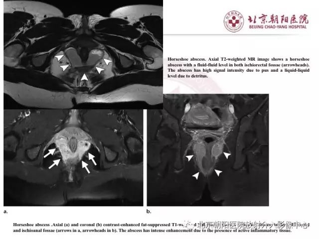 【PPT】肛瘘相关MRI影像学解剖及诊断