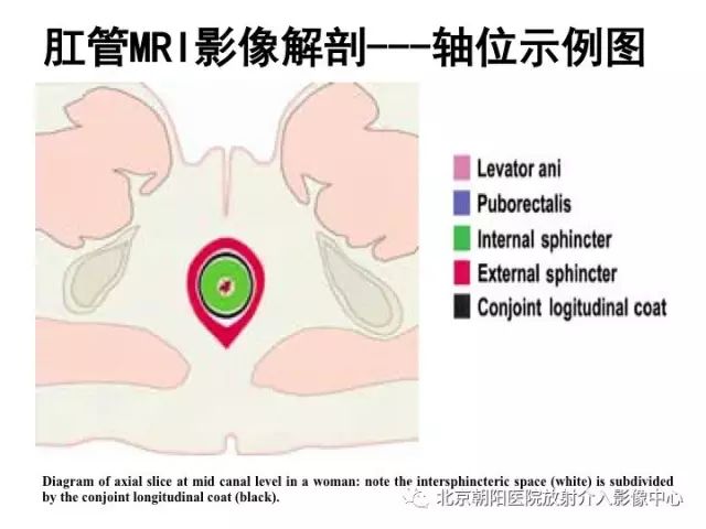 【PPT】肛瘘相关MRI影像学解剖及诊断