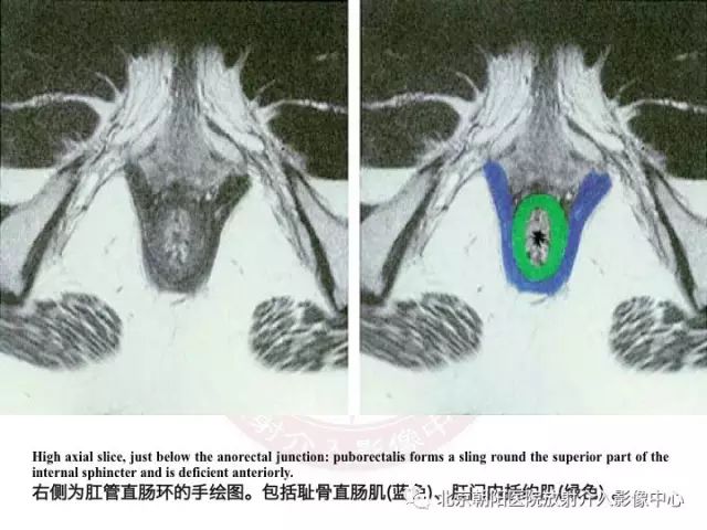 【PPT】肛瘘相关MRI影像学解剖及诊断