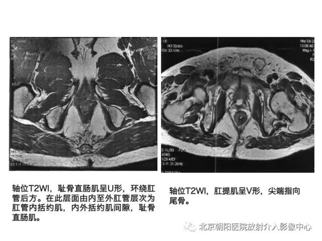 【PPT】肛瘘相关MRI影像学解剖及诊断