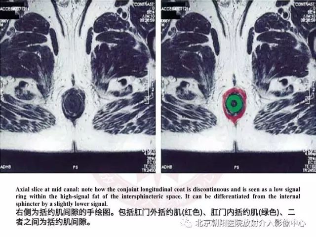 【PPT】肛瘘相关MRI影像学解剖及诊断