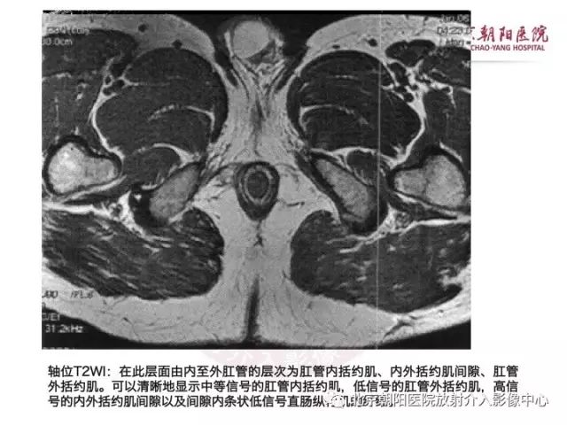 【PPT】肛瘘相关MRI影像学解剖及诊断