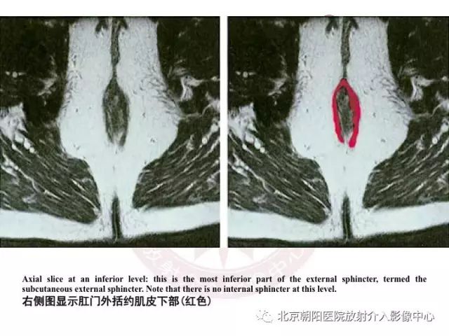 【PPT】肛瘘相关MRI影像学解剖及诊断