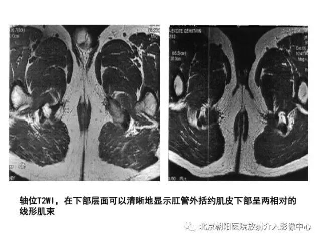 【PPT】肛瘘相关MRI影像学解剖及诊断